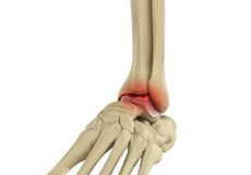 Foot and Ankle Arthritis