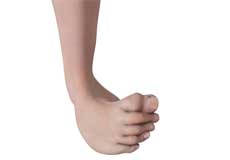 Congenital Deformity and Clubfoot