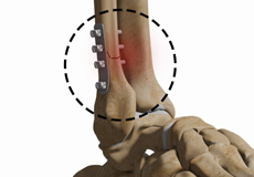 Complex Foot and Ankle Surgeries