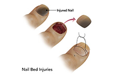 Nail Bed Injuries