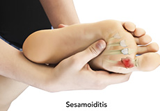 Sesamoid Fracture