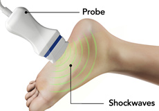 Shockwave Treatment for Plantar Fasciitis