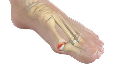 Stiff Big Toe (Hallux Rigidus)