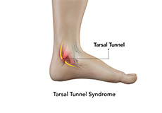 Tarsal Tunnel Syndrome