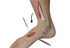 Tendon Transfer