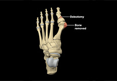 Treatment of Foot and Ankle Sports Injuries